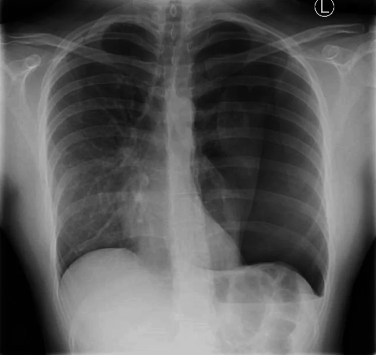 Röntgen-Thorax p.a.: linker Hemithorax hypertransparent ohne periphere Lungenzeichnung, die linke Lunge ist zum Hilus hin kollabiert, linkes Zwerchfell tiefstehend.