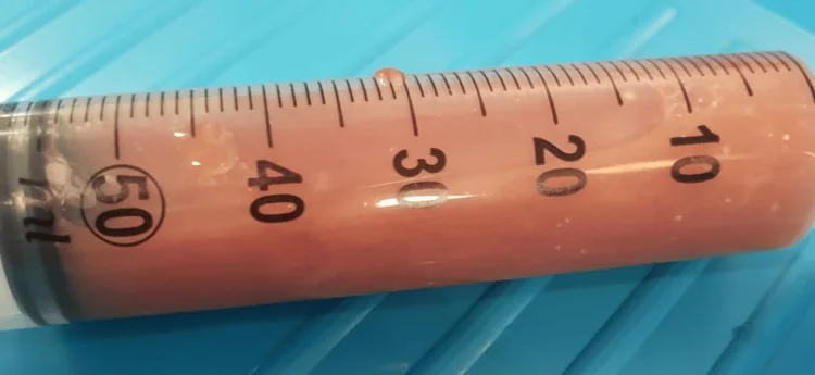 Eine 50-ml-Spritze ist mit trüber, dickflüssiger, rötlich-brauner Flüssigkeit gefüllt.