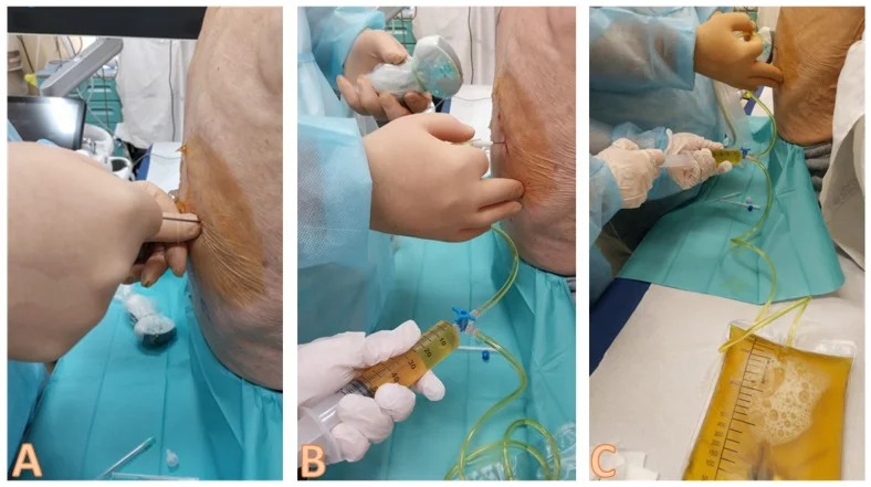 Drei Fotos einer Pleurapunktion am Rücken unter sterilen Bedingungen: A Einstich mit der Nadel, B Aspiration gelblicher Flüssigkeit über Spritze, Dreiwegehahn und Schlauch, C Sammelbeutel mit gelber Flüssigkeit.
