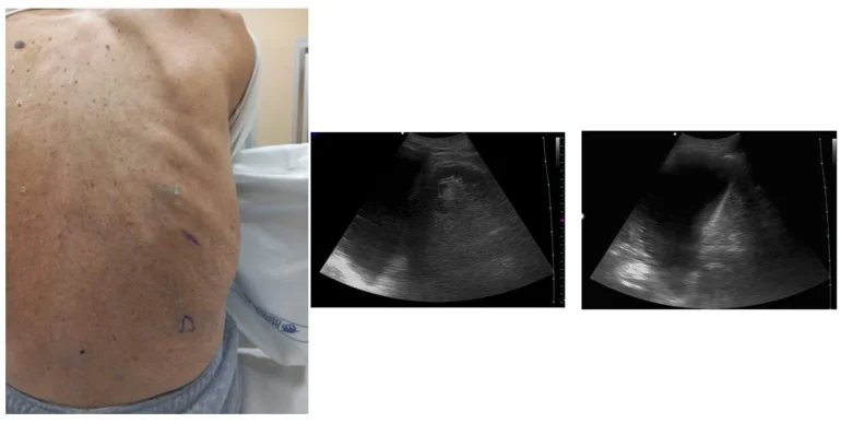 Rücken einer sitzenden Person mit zwei Hautmarkierungen im unteren Brustbereich, unten ein D; daneben zwei Sonografiebilder des Ergusses an der markierten Stelle.