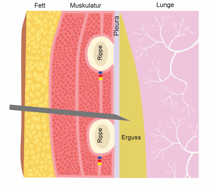 Querschnitt durch die Brustwand mit Fett, Muskulatur, zwei Rippen, Pleura, Erguss und Lunge; am Unterrand jeder Rippe liegen Vene, Arterie und Nerv als blauer, roter und gelber Punkt; die Nadel tritt knapp über dem Oberrand der unteren Rippe in den Erguss ein.