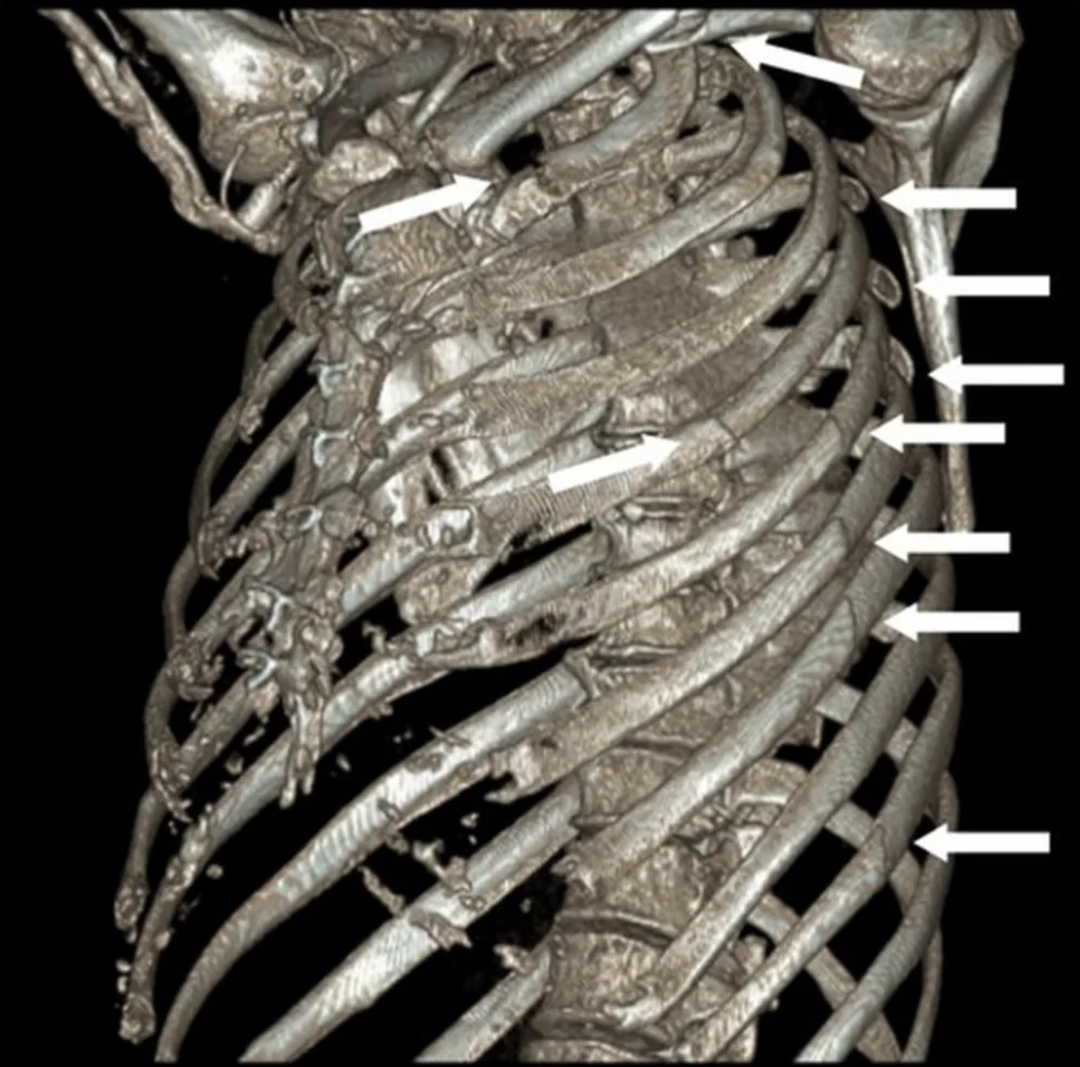 3D-CT-Rekonstruktion des linken Brustkorbs von schräg seitlich: zahlreiche Pfeile markieren Frakturen benachbarter Rippen in einer Linie seitlich und weitere Frakturen weiter vorn; zusätzlich ist die Klavikula betroffen.