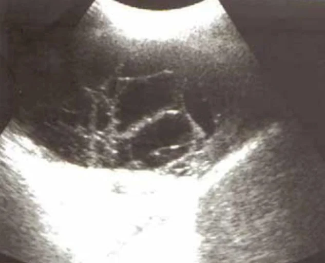 Thoraxsonografie: Ein dunkler, flüssigkeitsgefüllter Raum wird von zahlreichen hellen, netzartig verbundenen Strängen in viele kleine Kammern unterteilt.