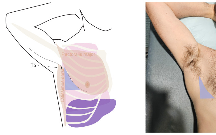 Links Zeichnung der seitlichen Brustwand mit M. pectoralis major, M. latissimus dorsi und einem blau markierten Dreieck unter der Achsel; rechts Foto eines liegenden Probanden mit erhobenem Arm und blau eingezeichnetem Dreieck an der seitlichen Brustwand.