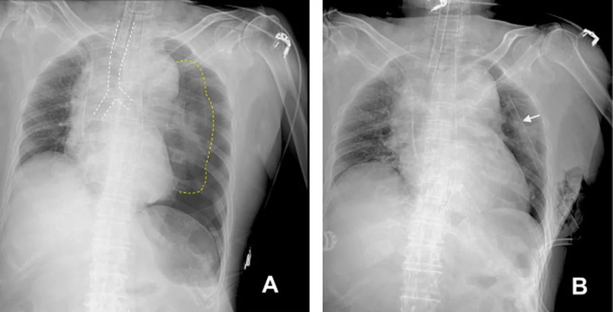 Liegend-Röntgenaufnahme unter Beatmung: links kollabierte Lunge, Trachea und Mediastinum nach rechts verlagert, linkes Zwerchfell tiefstehend; daneben dieselbe Patientin nach Entlastung und Thoraxdrainage mit wieder entfalteter Lunge.