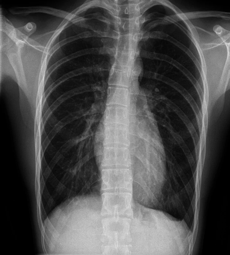 Röntgen-Thorax p.a.: Links apikal zieht eine feine Linie unterhalb der Thoraxkuppel; oberhalb davon fehlt die Lungengefäßzeichnung. Herz, Zwerchfelle und übrige Lunge ohne weiteren auffälligen Befund.
