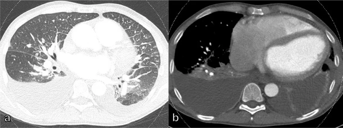 Zwei axiale CT-Schnitte desselben Patienten: links im Lungenfenster verdickte interlobuläre Septen und Milchglasverdichtungen beider Lungen, rechts im Weichteilfenster beidseitige dorsale Pleuraergüsse.