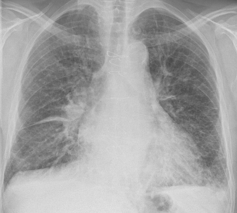 Frontale Thoraxaufnahme eines älteren Mannes mit Sternalcerclagen: vergrößerte Herzsilhouette, kräftige Lungengefäße, feine netzige Zeichnungsvermehrung beider Lungen und kurze horizontale Linien an der lateralen Lungenbasis.