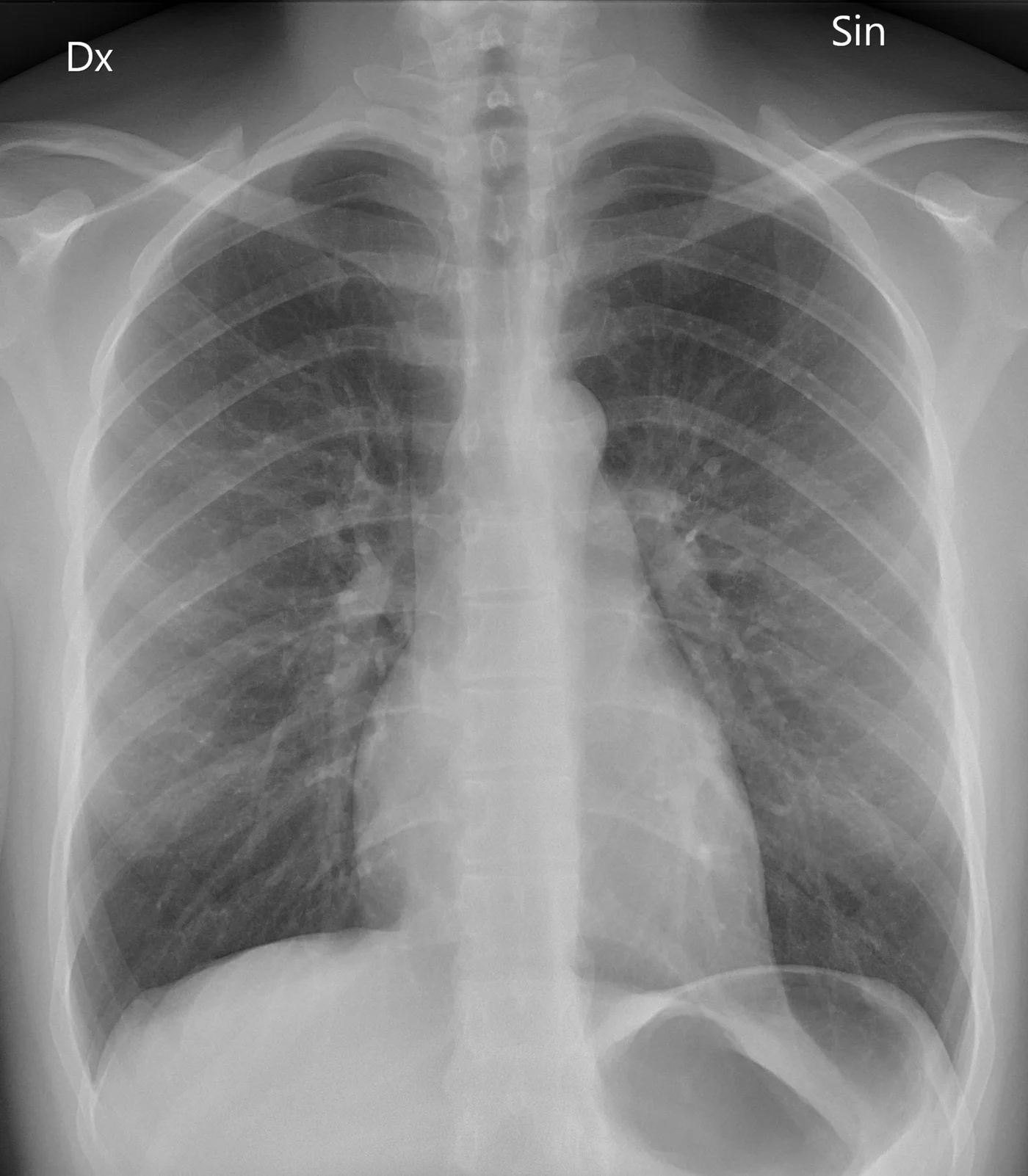 Normale Röntgenaufnahme des Thorax im posterior-anterioren Strahlengang bei einer jungen Frau, oben links Markierung Dx, oben rechts Sin