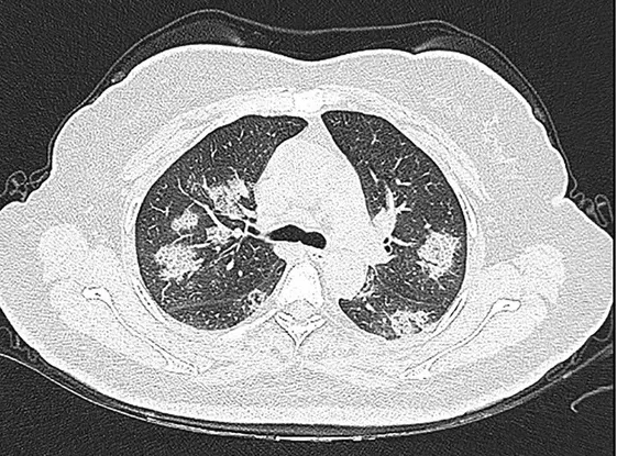 Axiales CT des Thorax im Lungenfenster mit mehreren fleckigen, zarten Trübungen in beiden Lungen, durch die die Gefäße hindurch sichtbar bleiben