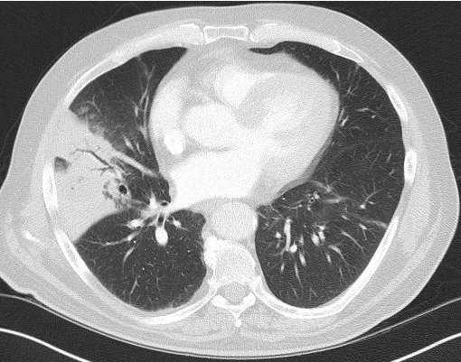 Axiales CT des Thorax im Lungenfenster mit dichter, weißer Verschattung im rechten Mittellappen, darin dunkle verzweigte Bronchien