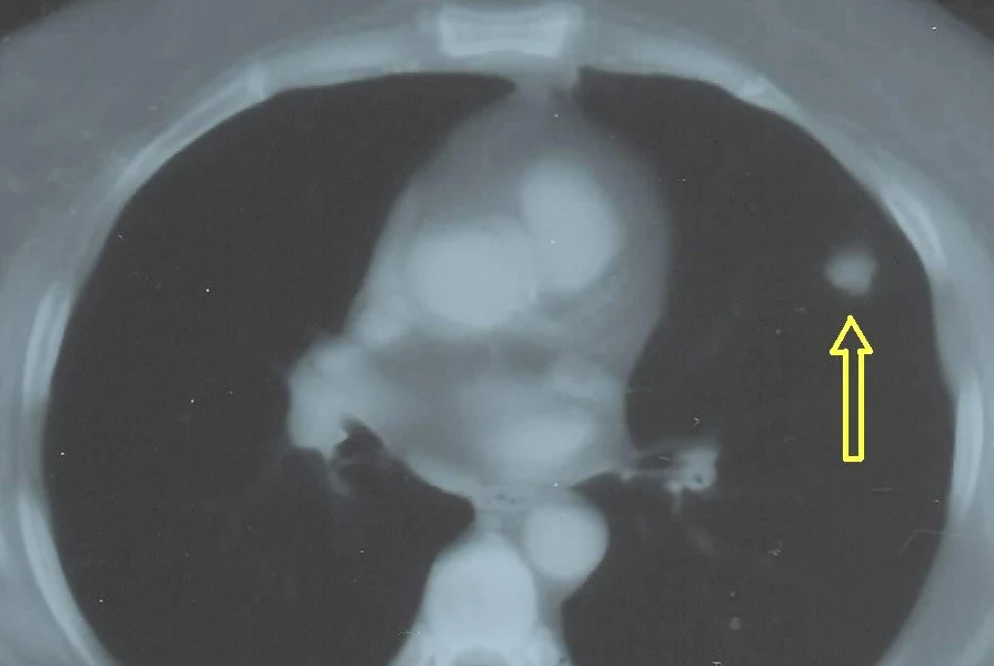 Axiales CT des Thorax mit einem einzelnen, rundlichen, glatt begrenzten Herd im linken Oberlappen, auf den ein gelber Pfeil zeigt