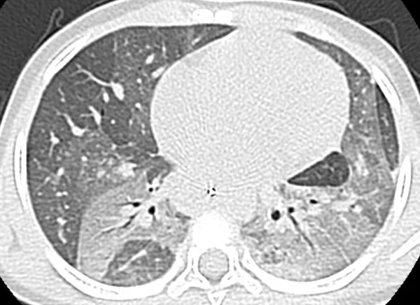 Axiales CT des Thorax im Lungenfenster in Höhe der Unterlappen mit flächigen hellgrauen Arealen in beiden dorsalen Unterlappen