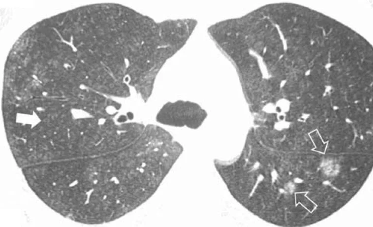 Axiales HRCT in Höhe der Hauptbronchien im Lungenfenster mit zahlreichen feinen, unscharfen Knötchen gleichmäßig in beiden Lungen; ein weißer Pfeil im Bild links, zwei umrandete Pfeile im Bild rechts auf zwei größere zarte Herde