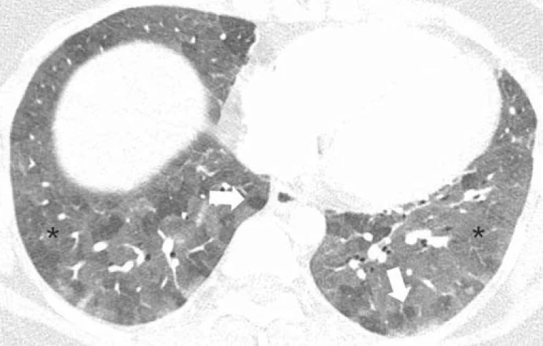 Axiales HRCT der Unterlappen im Lungenfenster mit fleckigem Nebeneinander hellerer, milchglasartig getrübter Areale und dunklerer, scharf begrenzter Lungenläppchen; Sternchen in den hellen Arealen, Pfeile auf dunkle Läppchen