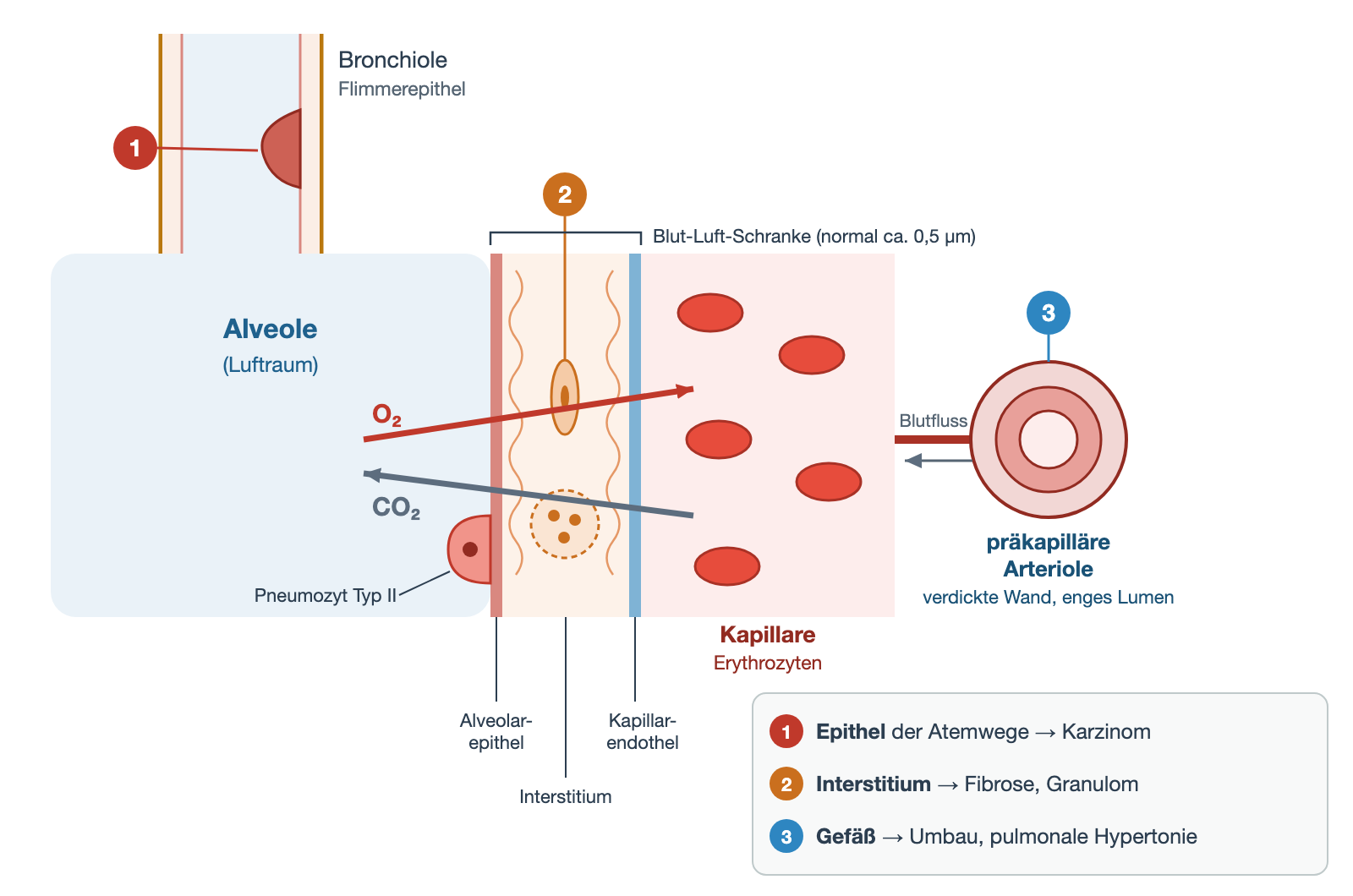 Schema der Gasaustauschstrecke: links eine Bronchiole und die Alveole, in der Mitte die Schichten Alveolarepithel, Interstitium und Kapillarendothel, rechts die Kapillare mit Erythrozyten und eine präkapilläre Arteriole; drei nummerierte Schadensorte