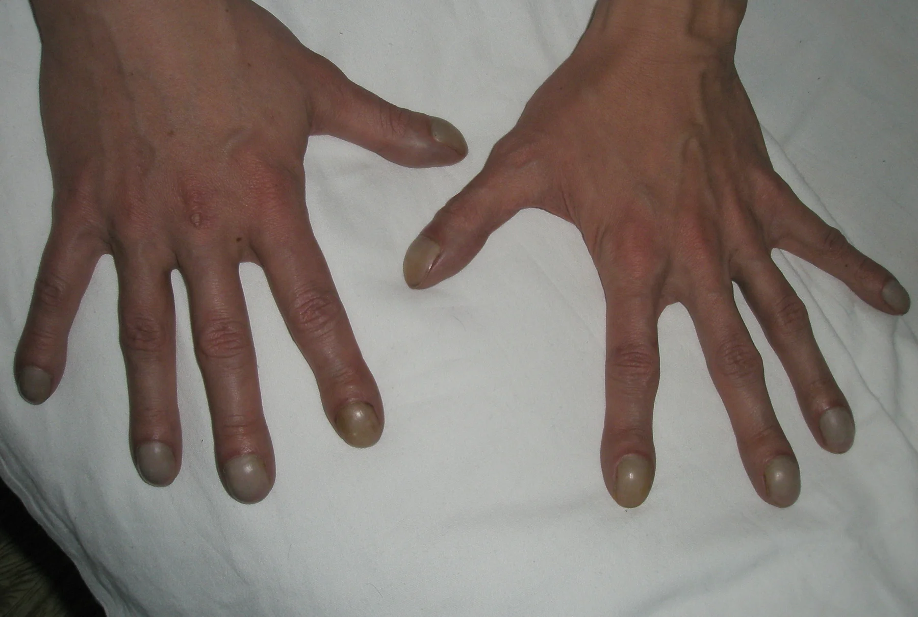 Foto beider Handrücken mit kolbig verdickten Fingerendgliedern und gewölbten Nägeln.