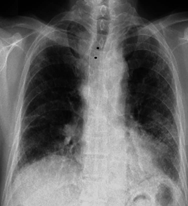 Röntgen-Thorax p.a. mit beidseitiger netzartiger Zeichnungsvermehrung, betont in den Unterfeldern, kleinen Lungenvolumina und verzogener Trachea.