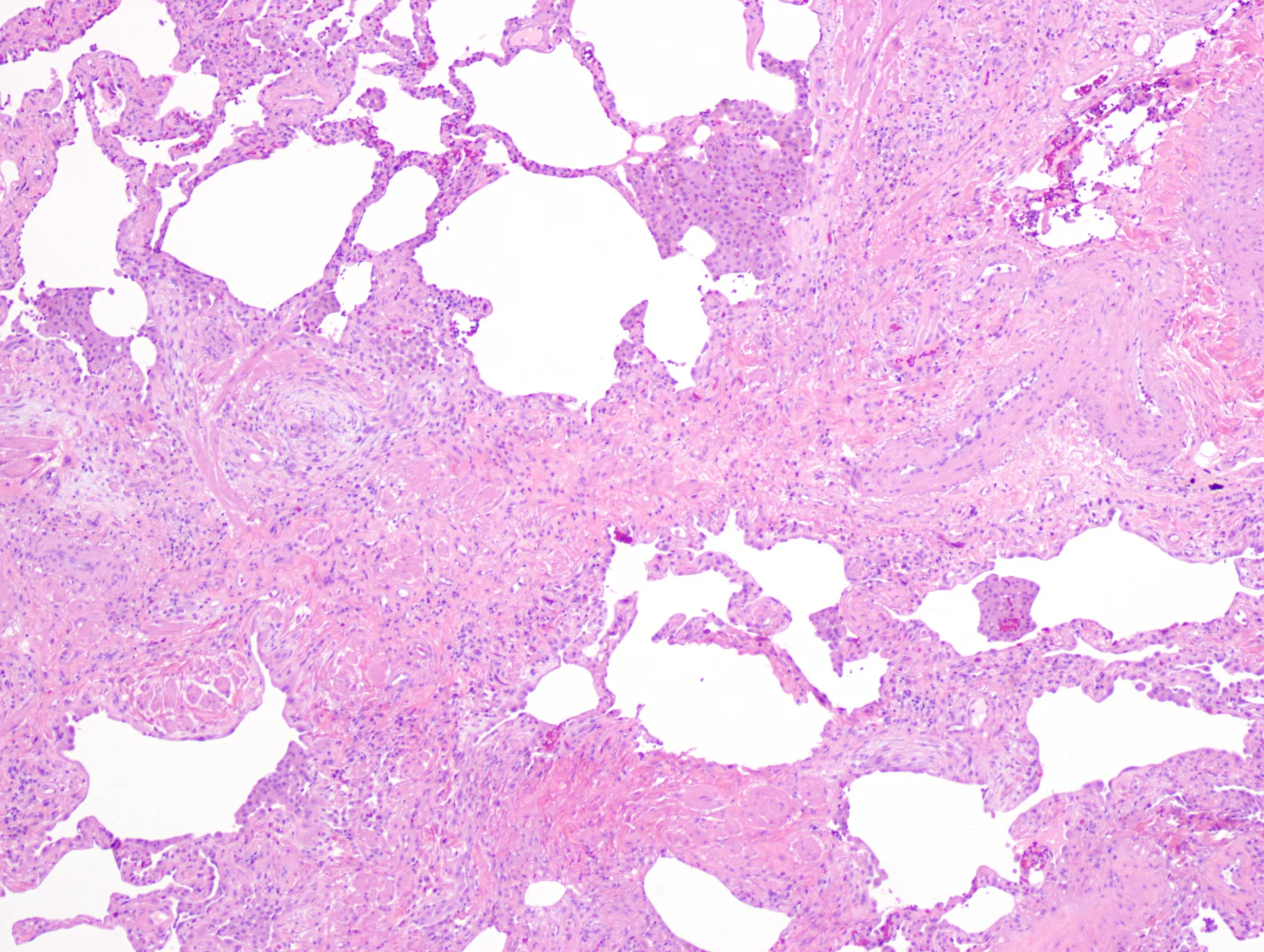 Histologisches Übersichtsbild einer Lungenbiopsie (HE-Färbung) mit rosafarbenen Fibrosearealen neben weitgehend erhaltenen Alveolen und zystisch erweiterten Lufträumen.