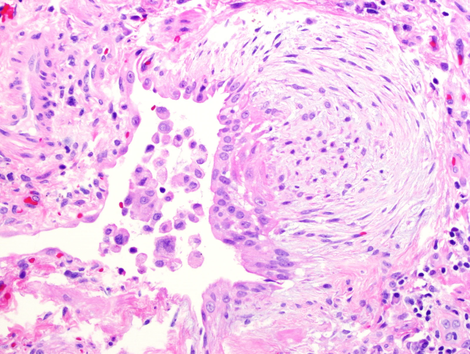 Histologisches Detailbild (HE-Färbung) mit einem hellen, wirbelartig angeordneten Herd aus spindelförmigen Fibroblasten unter einem Epithelüberzug.