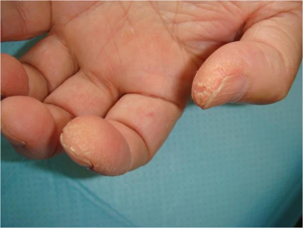 Hand mit rauer, schuppender und eingerissener Haut an der Daumenkuppe und an der radialen Seite des Zeigefingers.
