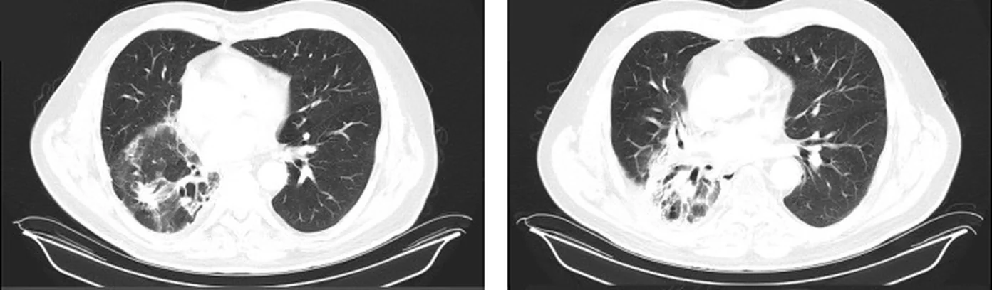 Zwei axiale CT-Schnitte desselben Patienten auf Höhe des Herzens: links eine Verdichtung mit Milchglas im ehemaligen Bestrahlungsfeld rechts dorsal, rechts derselbe Bereich geschrumpft mit Traktionsbronchiektasen.