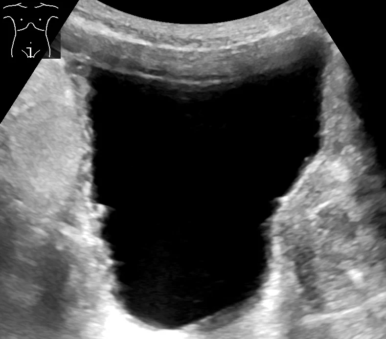 Ultraschall einer gut gefüllten Harnblase als großer echofreier Raum mit unregelmäßig verdickter, trabekulierter Wand.