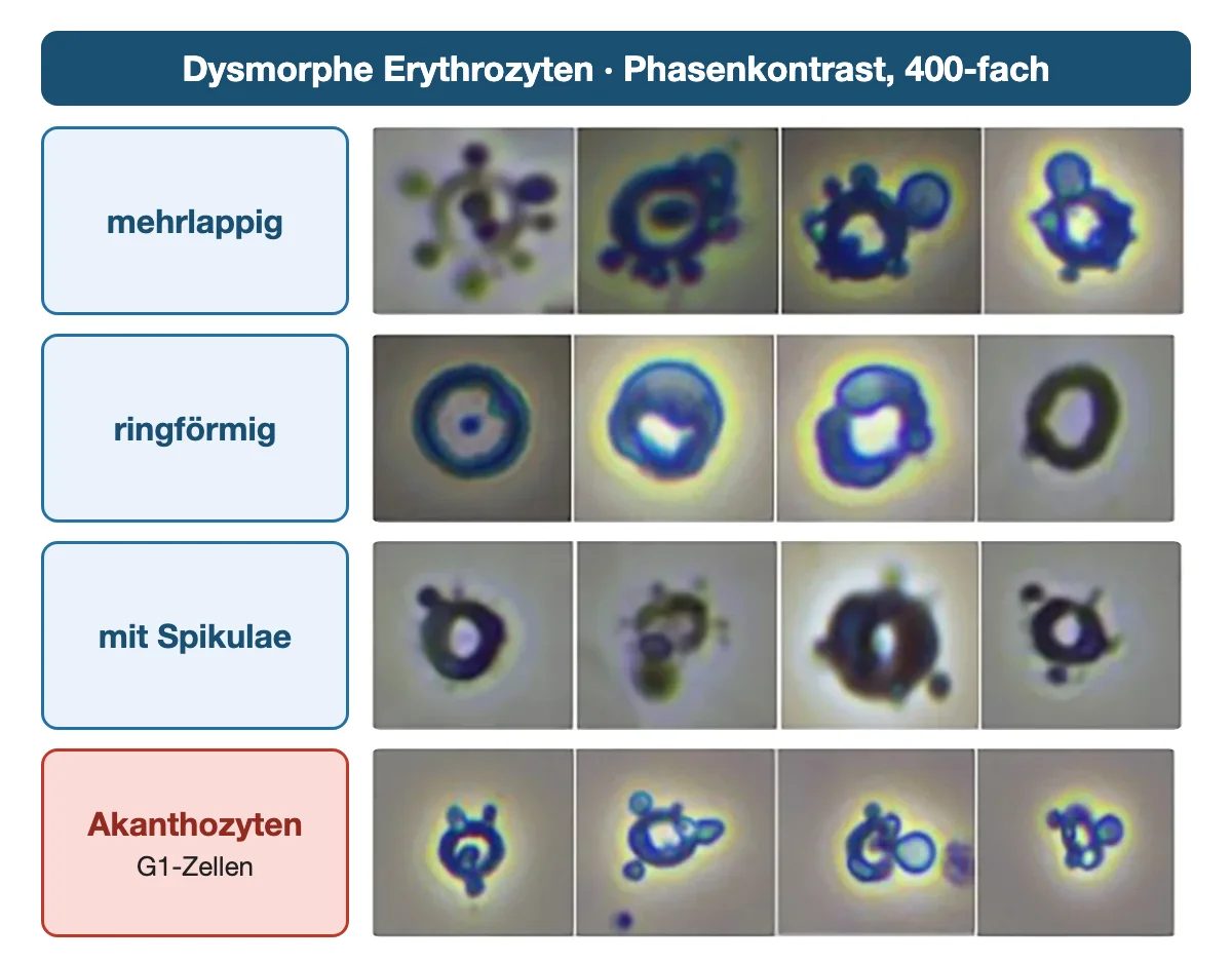 Phasenkontrastaufnahmen dysmorpher Erythrozyten in vier Reihen: mehrlappige, ringförmige, mit Spikulae besetzte Erythrozyten und Akanthozyten mit bläschenartigen Ausstülpungen.