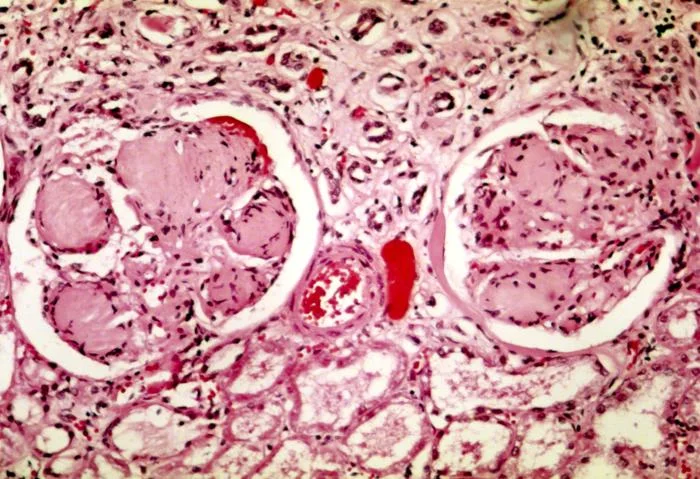 Lichtmikroskopisches Nierenbiopsat in HE-Färbung: zwei Glomeruli mit rosafarbenen, knotigen Verbreiterungen des Mesangiums, dazwischen Tubuli und eine Arteriole.