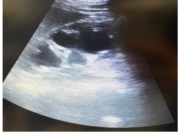 Vom Monitor fotografiertes Ultraschallbild einer Niere im Längsschnitt: im Zentrum mehrere große, miteinander verbundene, echofreie schwarze Räume, umgeben von einem grauen Gewebesaum.