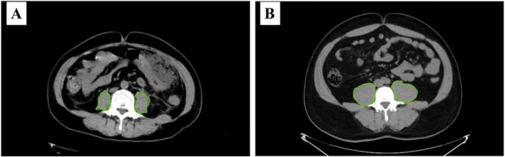 Zwei axiale CT-Schnitte des Bauches in Höhe des dritten Lendenwirbels nebeneinander, mit A und B bezeichnet; die beiden Lendenmuskeln neben dem Wirbelkörper sind grün umrandet und in A deutlich kleiner als in B.