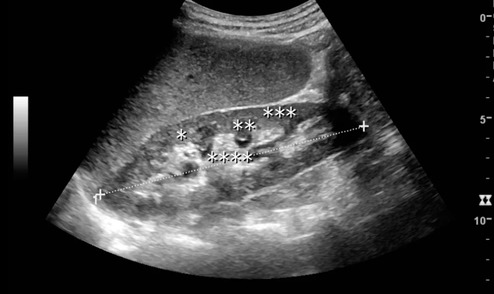 Ultraschall-Längsschnitt einer normalen Niere eines Erwachsenen mit gestrichelter Messlinie für die Nierenlänge; Rinde, Markpyramide, Bertin-Säule und zentraler Sinus sind mit Sternchen markiert.