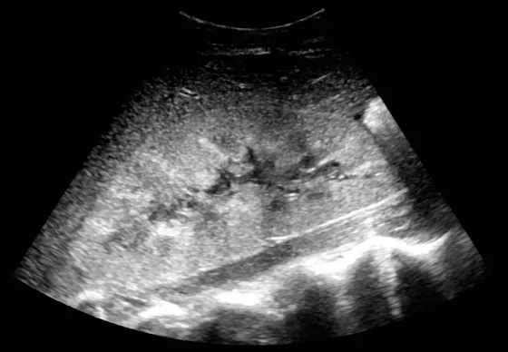 Ultraschall-Längsschnitt einer Niere: helles, körniges Parenchym; im Zentrum nur schmale, verzweigte dunkle Linien, aber kein großer zusammenhängender echofreier Raum.