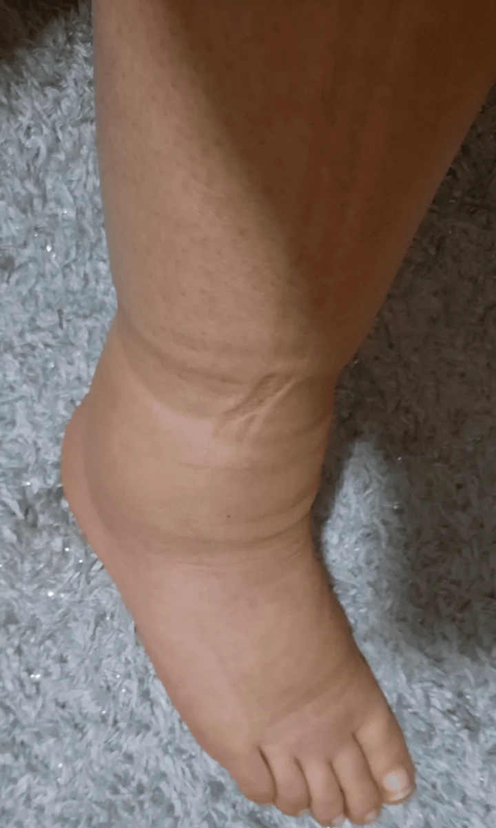 Fotografie eines geschwollenen Unterschenkels mit Knöchel und Fußrücken; über dem Knöchel bleibt eine ringförmige Eindellung vom Sockenbund sichtbar.