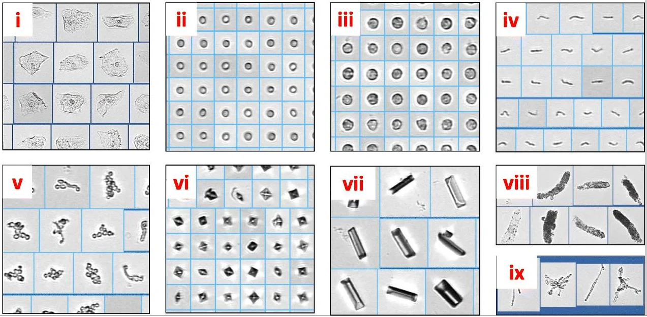 Neun mikroskopische Bildfelder aus Urinsedimenten: Plattenepithelzellen, Erythrozyten, Leukozyten, Bakterien, Hefen, Oxalatkristalle, Tripelphosphatkristalle, granulierte Zylinder und Pseudohyphen.