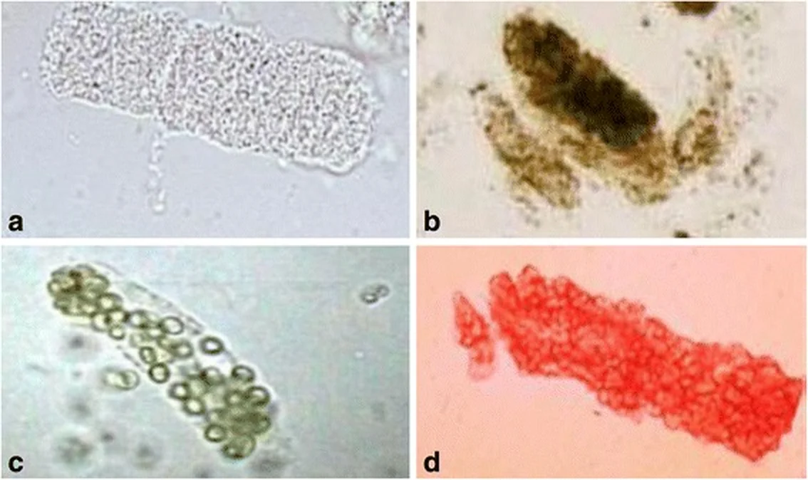 Vier Harnzylinder: a Tubulusepithelzylinder, b schmutzig-brauner grob granulierter Zylinder, c Leukozytenzylinder, d Erythrozytenzylinder.