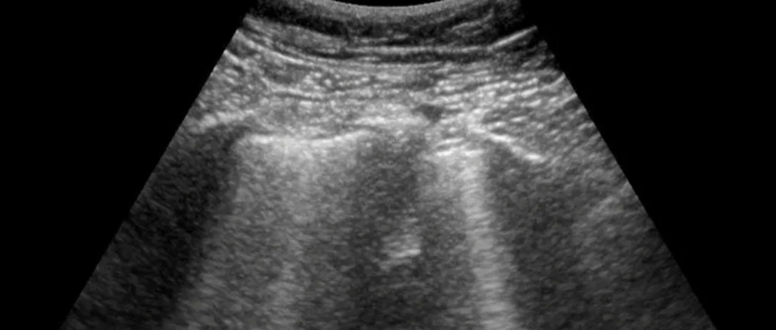 Lungenultraschall mit heller Pleuralinie im oberen Bilddrittel; von ihr ziehen mehrere helle, senkrechte Streifen ohne Abschwächung bis zum unteren Bildrand.