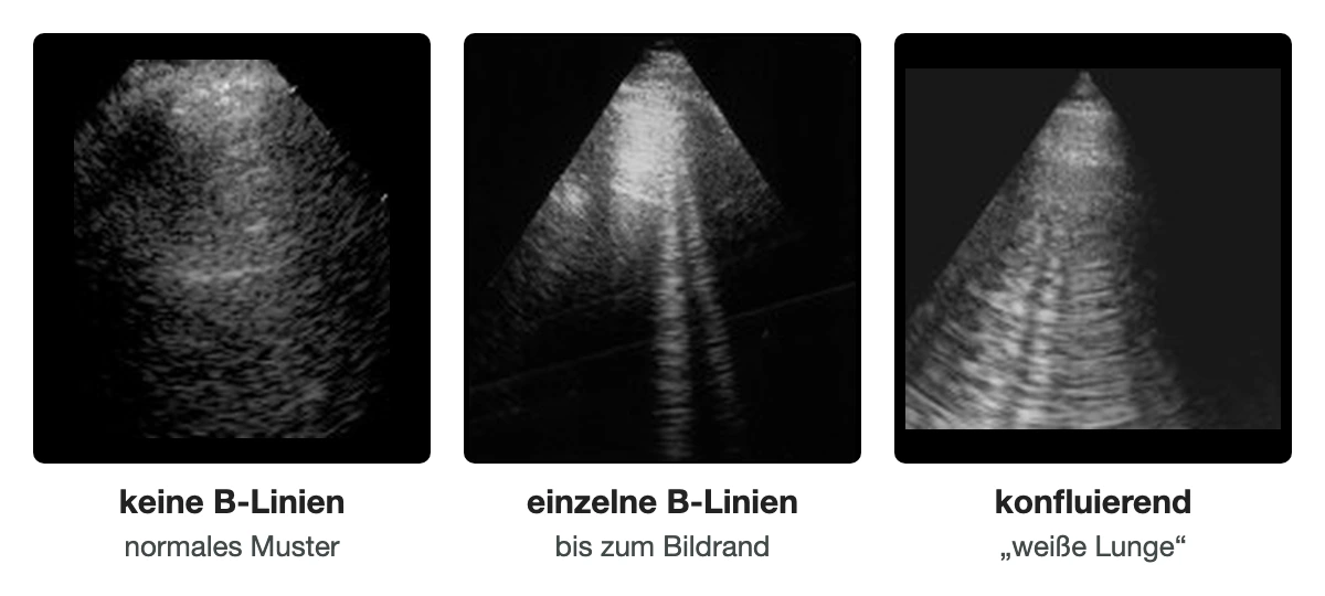 Drei Lungenultraschallbilder mit Sektorschallkopf nebeneinander: links keine B-Linien, in der Mitte einzelne helle senkrechte Streifen von der Pleuralinie bis zum unteren Bildrand, rechts dicht nebeneinanderliegende, verschmelzende Streifen.