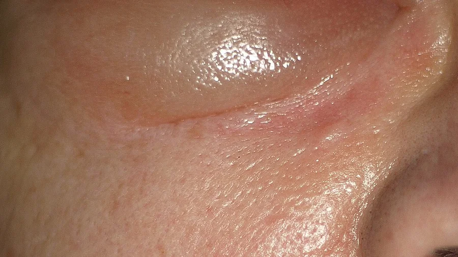 Nahaufnahme der Gesichtshaut unterhalb eines Auges: Das Unterlid ist prall vorgewölbt, die Haut darüber glatt, gespannt, glänzend und leicht gerötet; zur Wange hin begrenzt eine Hautfalte die Schwellung.