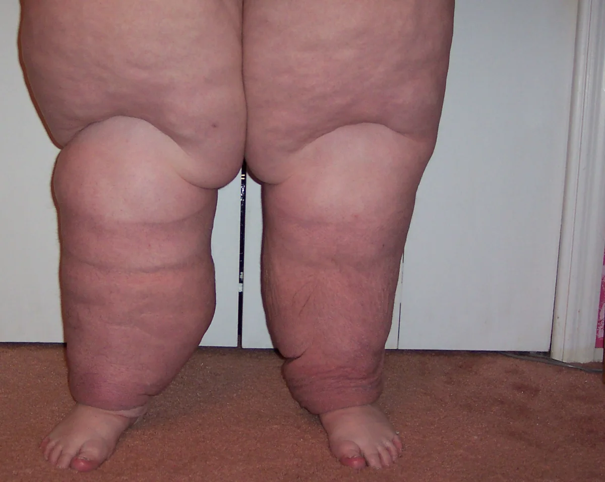 Beide Beine von vorn mit massiver Schwellung von Oberschenkeln, Unterschenkeln und Fußrücken; tiefe Hautfalten über Knie und Knöcheln, auch die Zehen sind verdickt.