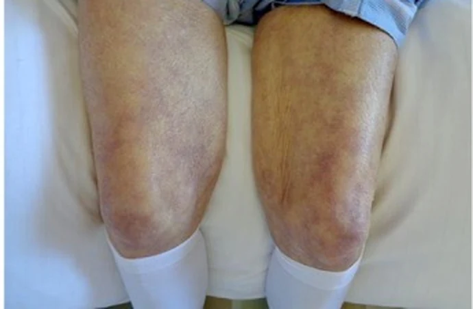 Beide Knie einer liegenden Person von vorn: netzartige, livide bis violette Flecken auf blassem Hautgrund über den Kniescheiben und den angrenzenden Oberschenkeln.