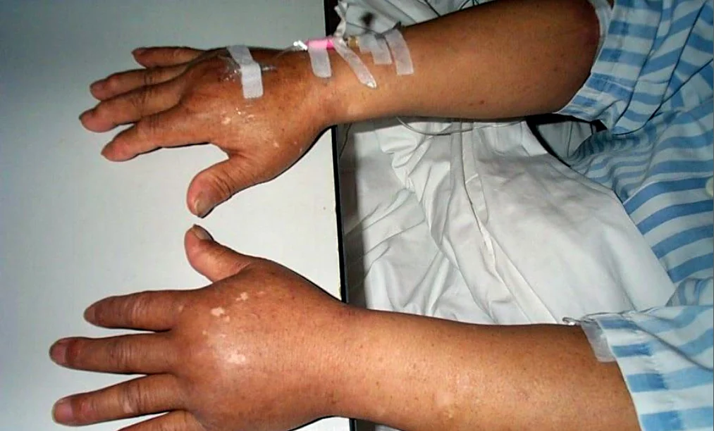 Beide Hände und Unterarme eines liegenden Patienten mit deutlicher Schwellung von Handrücken und Fingern; an einem Handrücken liegt ein Venenzugang.