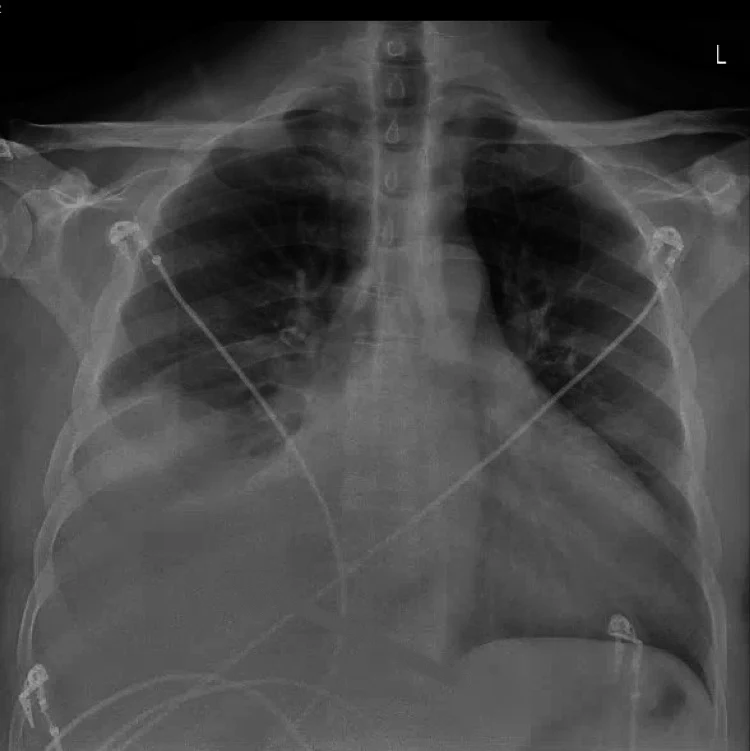 Röntgen-Thorax im Liegen von vorn: breiter Herzschatten; die rechte Lungenbasis ist großflächig homogen verschattet, die rechte Zwerchfellkontur nicht abgrenzbar; EKG-Elektroden und Kabel auf dem Brustkorb.