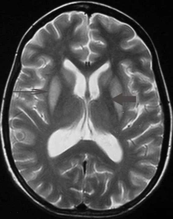 Axiale T2-gewichtete MRT in Höhe der Basalganglien: beidseits symmetrische Hyperintensitäten im Putamen, links mit dünnem Pfeil markiert; ein breiter Pfeil zeigt auf den ausgesparten Globus pallidus. Befund einer extrapontinen Myelinolyse.