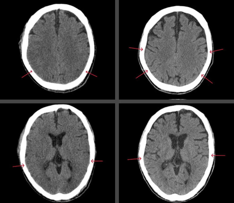 Vier axiale CT-Schichten des Kopfes: links bei Aufnahme mit verstrichenen Hirnfurchen, markiert durch rote Pfeile, rechts nach Behandlung mit wieder sichtbaren Furchen in denselben Höhen. Obere Reihe hohe Schicht, untere Reihe Höhe der Seitenventrikel.