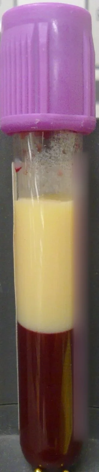 Blutröhrchen nach mehrstündigem Stehen: Über den abgesetzten roten Blutzellen liegt eine dicke, milchig-gelbe Plasmaschicht bei schwerer Hypertriglyzeridämie.