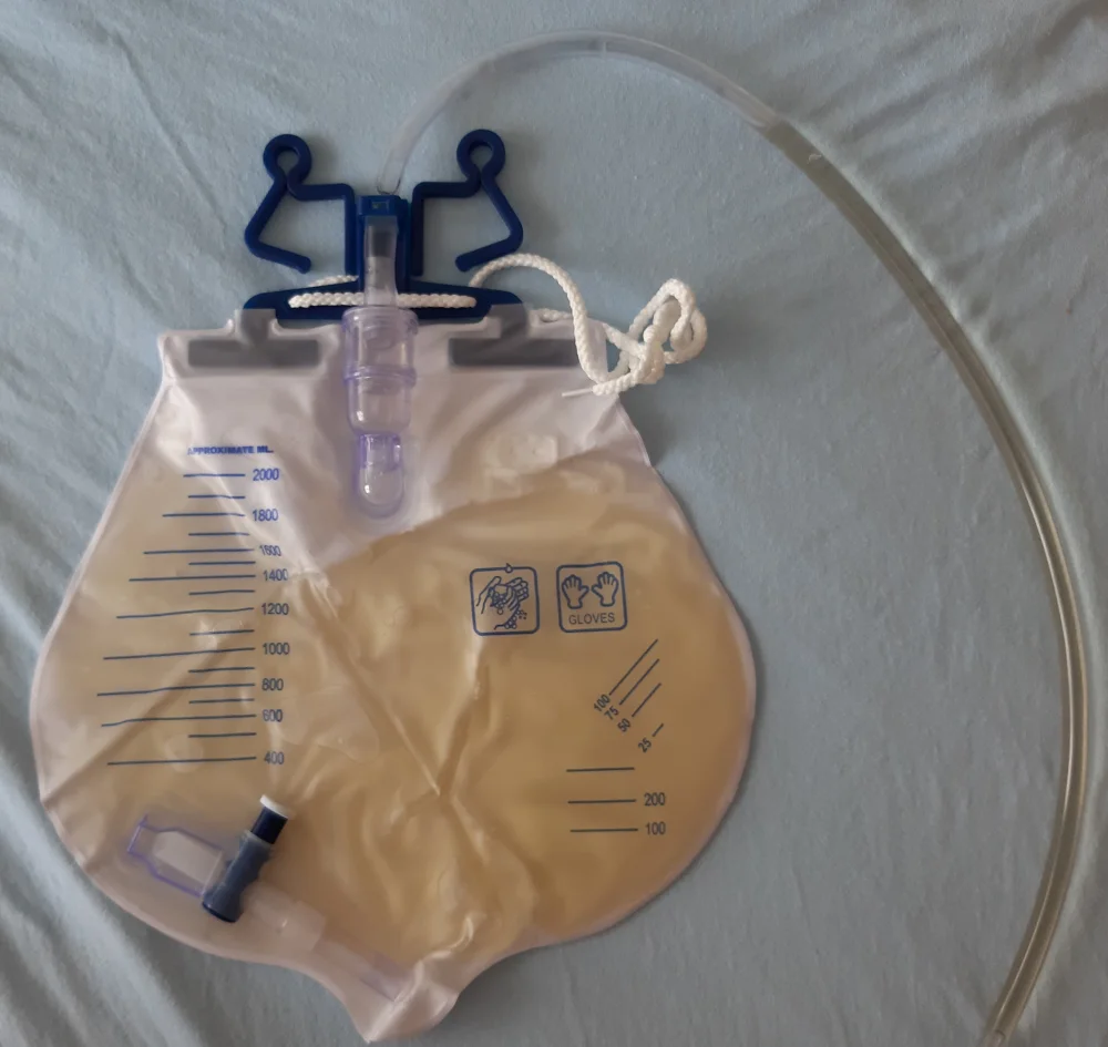 Urinauffangbeutel eines Blasenkatheters auf einer Unterlage, mit Zuleitungsschlauch, Aufhängung und Ablasshahn; aufgedruckte Milliliterskala bis 2000 ml, der Beutel ist teilweise mit hellgelbem Urin gefüllt.