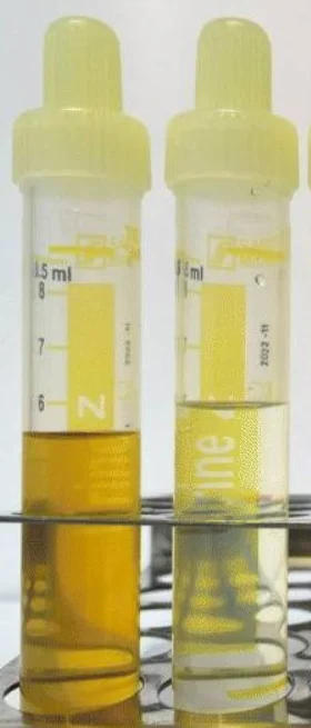 Zwei Urinröhrchen nebeneinander im Ständer: links kräftig dunkelgelber Urin, rechts fast farbloser, wasserklarer Urin.