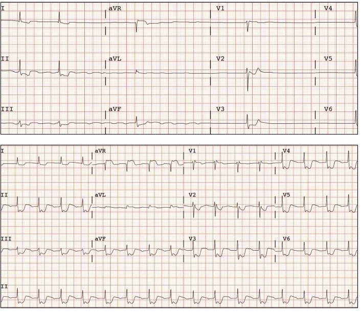 Zwei reale Zwölfkanal-EKG derselben Person untereinander. Oben ein sehr langsamer Rhythmus mit nur wenigen schmalen Kammerkomplexen und langen flachen Pausen. Unten ein regelmäßiger schnellerer Rhythmus mit schmalen Kammerkomplexen; in II, III, aVF und V4 bis V6 senkt sich die ST-Strecke muldenförmig ab.