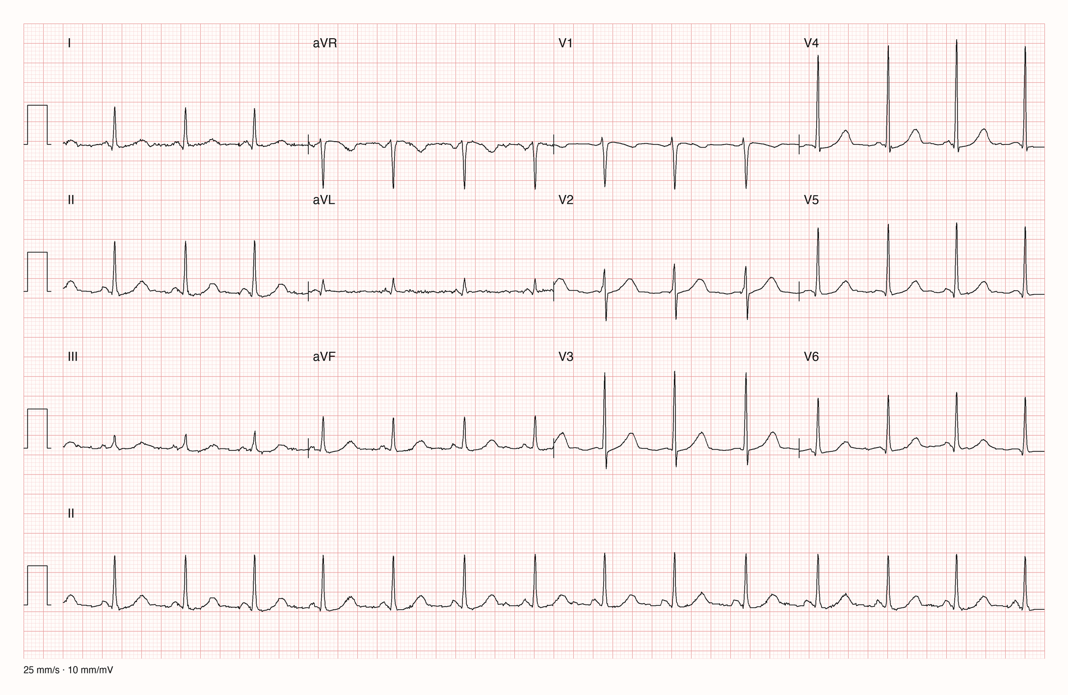 Reales Zwölfkanal-EKG mit Rhythmusstreifen II bei 25 mm/s und 10 mm/mV: regelmäßiger Rhythmus um 80/min mit einer P-Welle vor jedem schmalen QRS-Komplex; die T-Wellen sind abgerundet und in I, II, aVF und V2 bis V6 positiv.